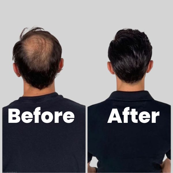 FORTALON™ Hair.Health.Him